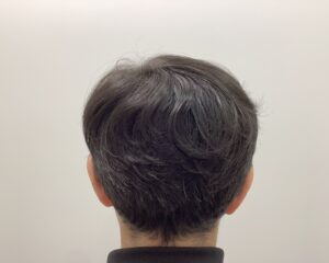 AGA治療11ヶ月後　42歳男性　生え際・頭頂部改善　新潟院