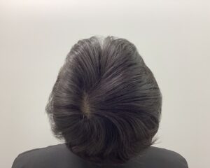 AGA治療11ヶ月後　42歳男性　生え際・頭頂部改善　新潟院