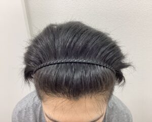 AGA治療5ヵ月後　31歳男性　生え際・頭頂部改善　新潟院