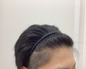 AGA治療5ヵ月後　31歳男性　生え際・頭頂部改善　新潟院