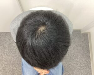 AGA治療5ヵ月後　31歳男性　生え際・頭頂部改善　新潟院