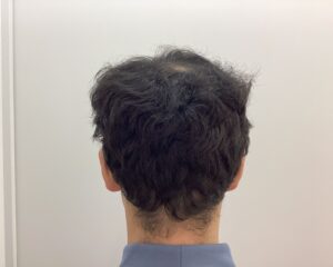 AGA治療前 38歳男性 生え際・頭頂部薄毛 新潟院
