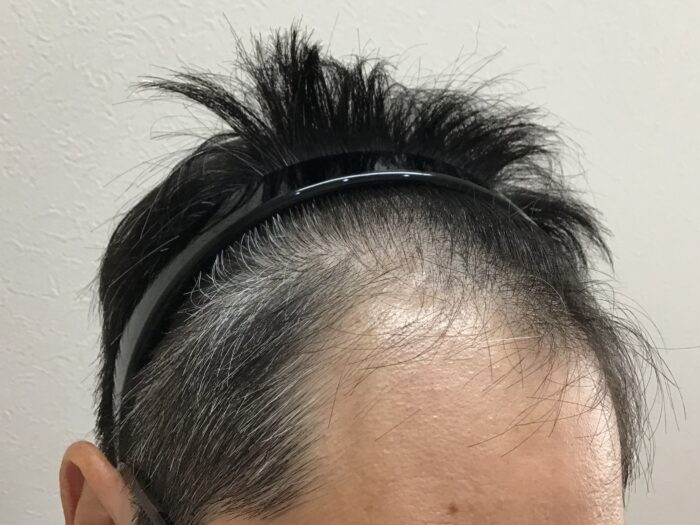 AGA治療前 48歳男性 M字薄毛 鹿児島院