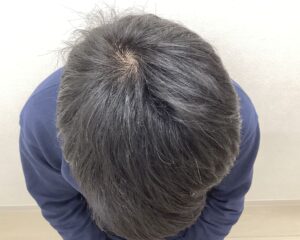AGA治療5ヵ月経過　28歳男性　頭頂部　横浜院