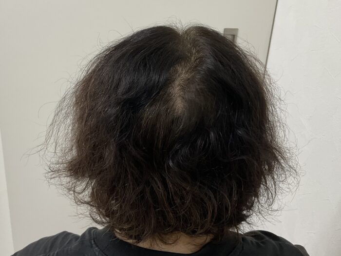 FAGA治療前　50歳女性　生え際・分け目薄毛　岡山院