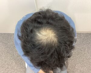 AGA治療前 38歳男性 生え際・頭頂部薄毛 新潟院