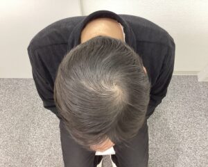 AGA治療前　42歳男性　生え際・頭頂部薄毛　新潟院