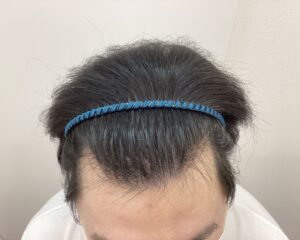 AGA治療前 28歳男性 前頭・頭頂部薄毛 新潟院