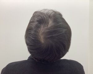 AGA治療前　42歳男性　生え際・頭頂部薄毛　新潟院