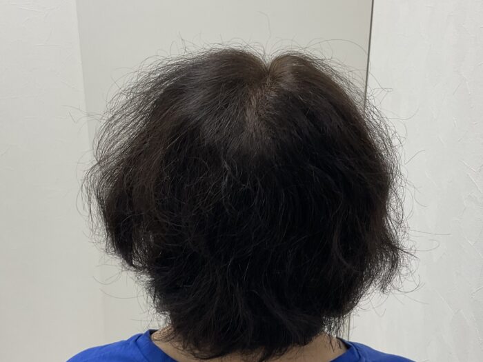 FAGA治療12ヵ月後　50歳女性　生え際・分け目薄毛改善　岡山院