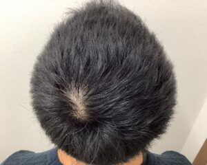 AGA治療後＿33歳男性＿生え際・頭頂部の改善＿広島院