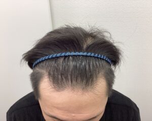 AGA治療前　42歳男性　生え際・頭頂部薄毛　新潟院