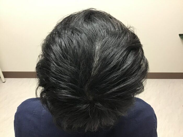 AGA治療開始約2ヶ月後 48歳男性 頭頂部発毛 鹿児島院