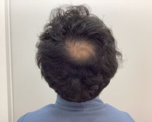 AGA治療前 38歳男性 生え際・頭頂部薄毛 新潟院
