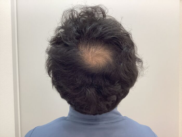 【38歳男性】生え際・頭頂部の薄毛がAGA治療で改善中｜新潟院