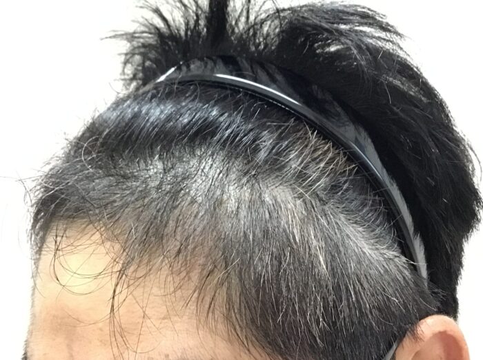 AGA治療開始約9ヶ月後 48歳男性 M字改善 鹿児島院