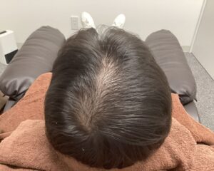 AGA治療前　42歳男性　生え際・頭頂部薄毛　新潟院