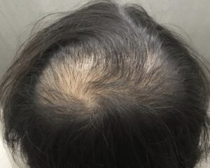 AGA治療前　40歳男性　頭頂部薄毛　京都院
