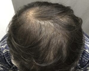 円形治療4ヶ月後　54歳男性　多発型頭頂部改善　京都院
