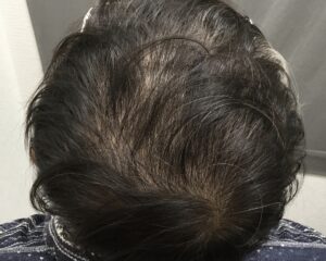 円形治療4ヶ月後　54歳男性　多発型頭頂部改善　京都院