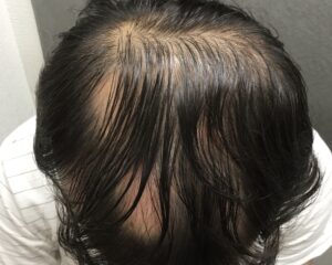 円形治療前　54歳男性　多発型頭頂部　京都院