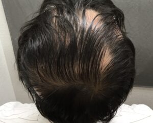 円形治療前　54歳男性　多発型頭頂部　京都院