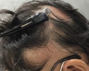円形治療前　54歳男性　多発型側頭部　京都院