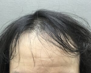 AGA治療前　40歳男性　前頭部薄毛　京都院