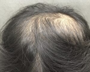 AGA治療前　40歳男性　頭頂部薄毛　京都院
