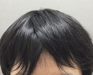 AGA治療8ヶ月後　40歳男性　前頭部改善　京都院