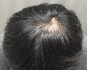 AGA治療8ヶ月後　40歳男性　頭頂部改善　京都院
