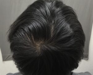 AGA治療8ヶ月後　40歳男性　頭頂部改善　京都院
