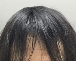 AGA治療5ヶ月後　40歳男性　前頭部改善　京都院