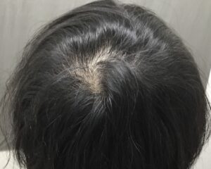 AGA治療5ヶ月後　40歳男性　頭頂部改善　京都院