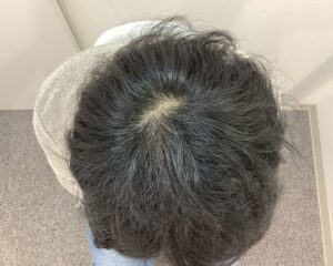 AGA治療前　31歳男性　生え際・頭頂部薄毛　新潟院