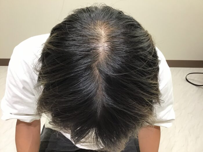 【39歳男性】頭頂・分け目の薄毛がAGA治療で改善｜鹿児島院