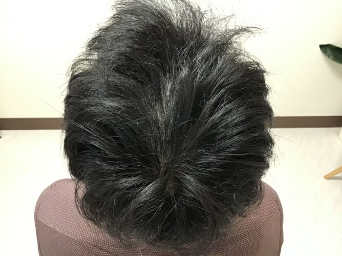 AGA治療開始約9ヶ月後 48歳男性 頭頂部改善 鹿児島院