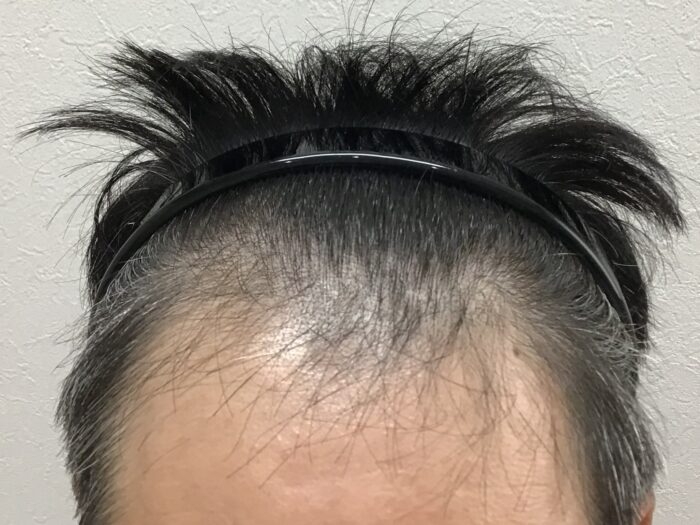 AGA治療前 48歳男性 生え際薄毛 鹿児島院