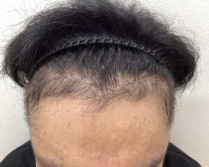 AGA治療12ヵ月経過　48歳男性　生え際　横浜院