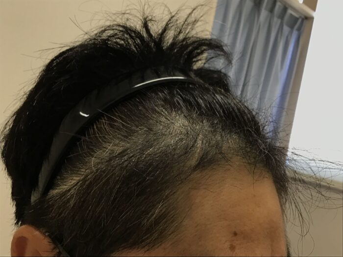 AGA治療開始約9ヶ月後 48歳男性 M字改善 鹿児島院