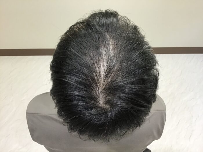 AGA治療前 48歳男性 頭頂部薄毛 鹿児島院