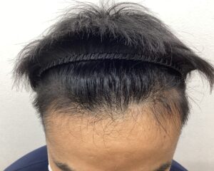 AGA治療5ヵ月経過　28歳男性　生え際　横浜院