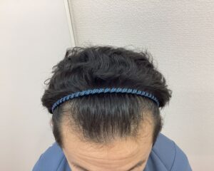 AGA治療前 38歳男性 生え際・頭頂部薄毛 新潟院