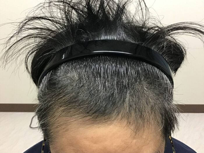 AGA治療開始約2ヶ月後 48歳男性 生え際発毛 鹿児島院