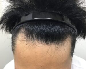 AGA治療前＿28歳男性＿生え際の薄毛＿大阪梅田院