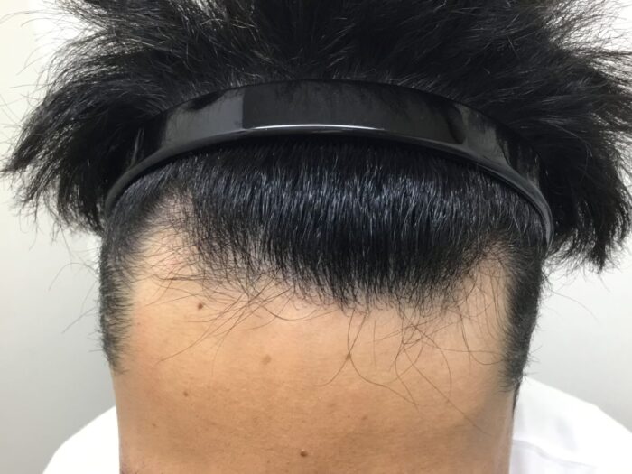【28歳男性】生え際の薄毛がAGA治療で改善｜大阪梅田院