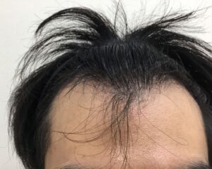 AGA治療前＿32歳男性＿生え際・頭頂部の薄毛＿大阪梅田院