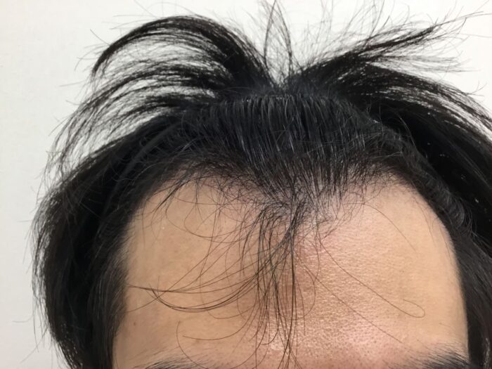 【32歳男性】生え際・頭頂部の薄毛がAGA治療で改善｜大阪梅田院