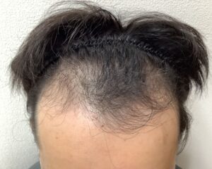 AGA治療前_23歳男性_生え際・頭頂部の薄毛_広島院