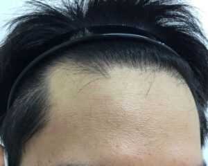 AGA治療前＿29歳男性＿生え際の薄毛＿大阪梅田院